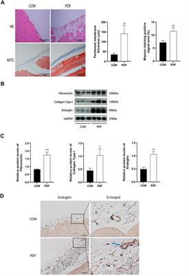 Endoglin aggravates peritoneal fibrosis by regulating the activation of TGF-β/ALK/Smads signaling
